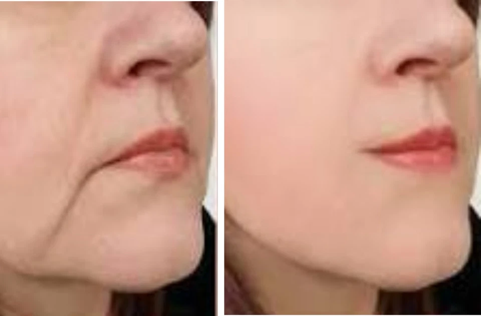 Biodroga Effect Care Lifting Boost Oil Concentrado 2ml-24pk. Paquete de ahorro Foto 2 de 4