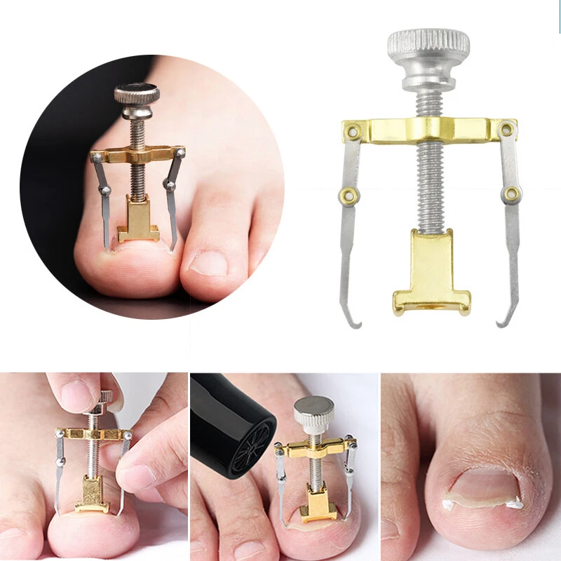 Ingrown toenail kit deals