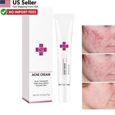 Acne Pimple Cream Oil Control Fast Treatment Oily Skin Cruelty Free FROM USA