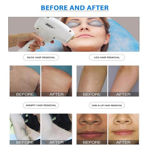 755NM+808NM+1064NM Diode Laser Tattoo Hair Removal Facial Rejuvenation Machine - Picture 15 of 15