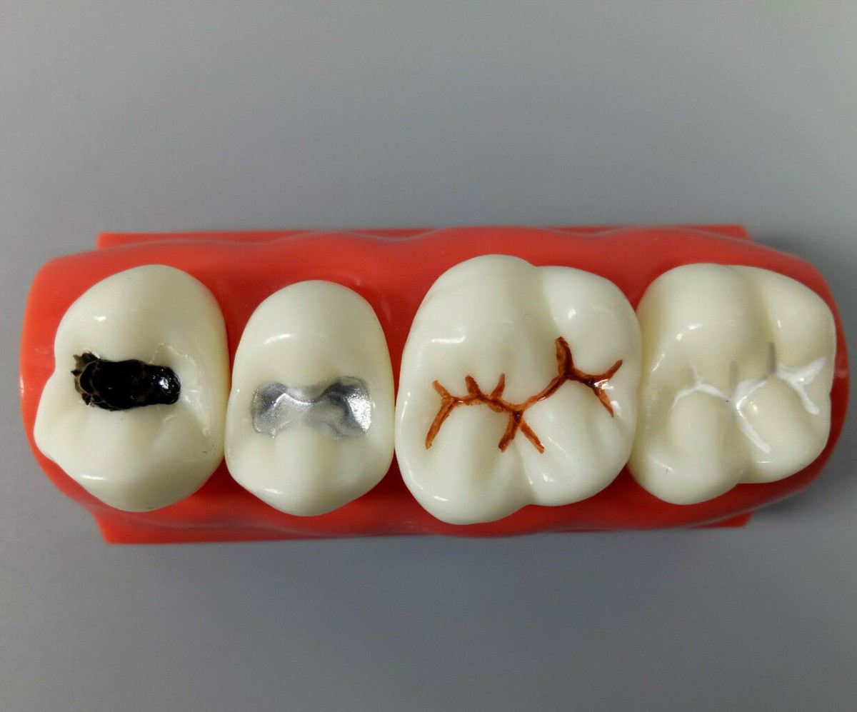 Pit And Fissure Sealants