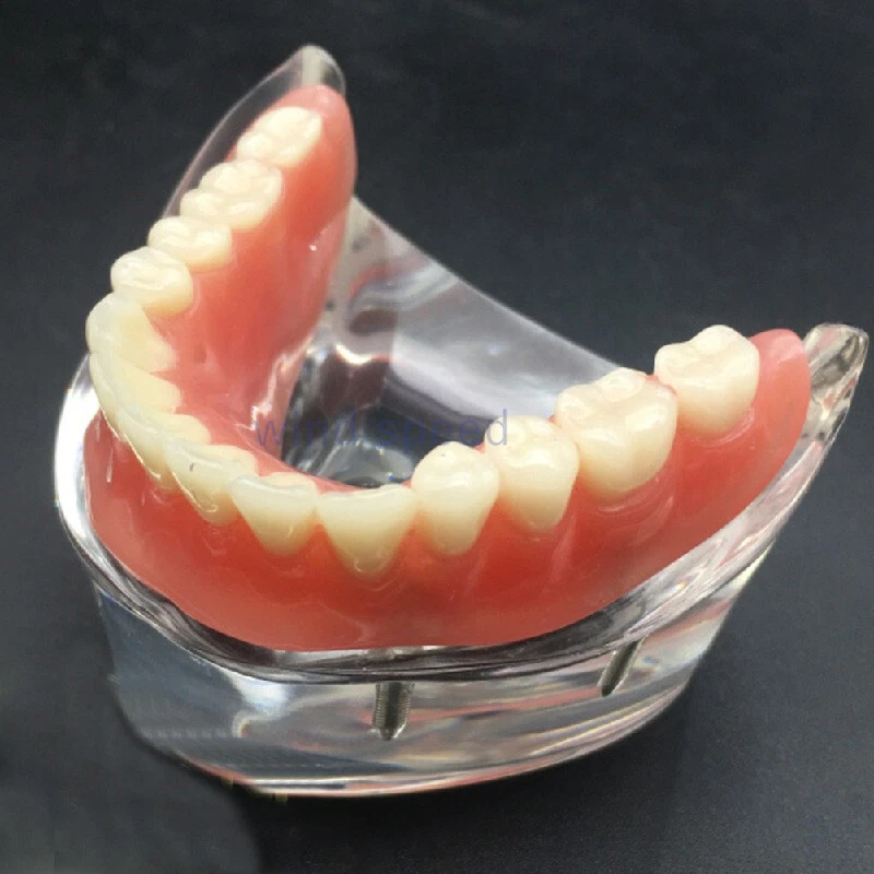 Modelo de implante dental demostración restauración de sobredentaduras postizas con 2 4 implantes inferiores Foto 3 de 4