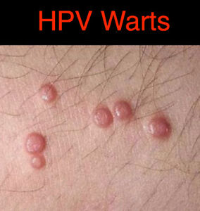 Hpv warts left untreated, Human papillomavirus infection untreated