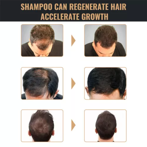 1-5X Root Activator Shampoo, SPARTAN Hair Loss Shampoo,Shampoo Root Activator - Picture 6 of 9