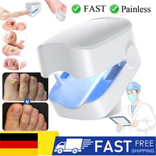 Laser Nagelpilz Pilz Nageltherapie Lasergerät Pilzlazer für Heimgebrauch Stabil - Bild 6 von 9