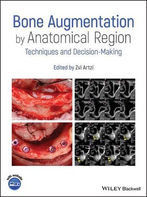Bone Augmentation by Anatomical Region: Techniques and Decision-Making by Zvi Ar