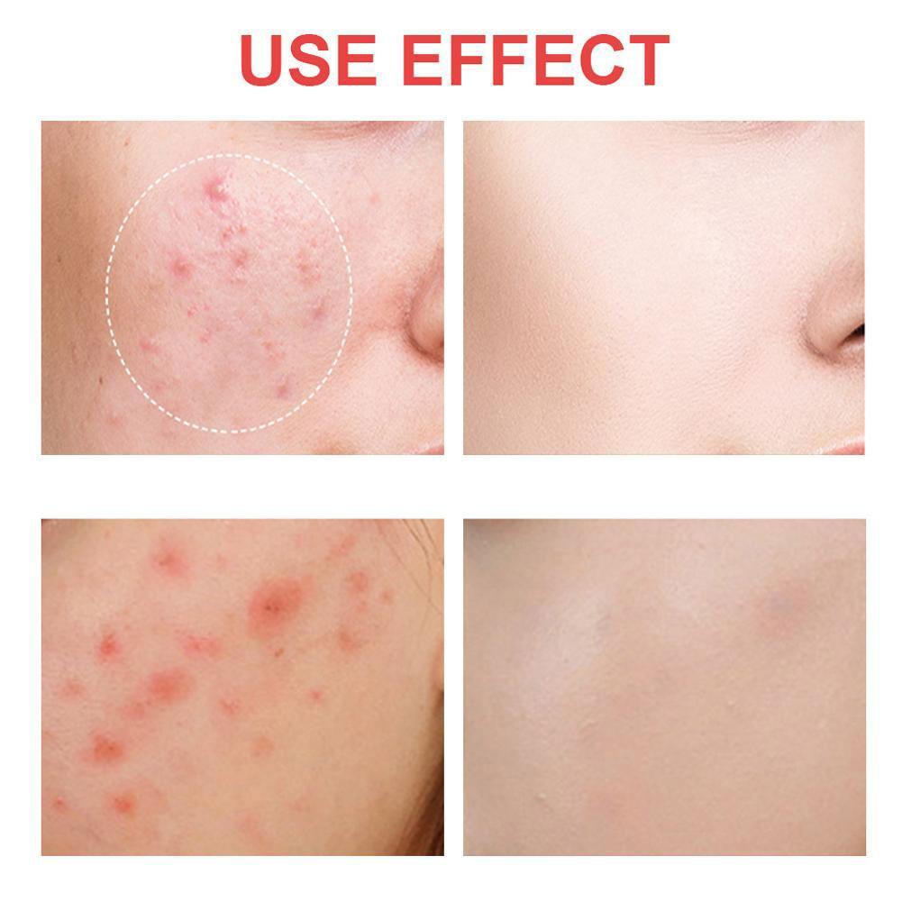 216 Pimple Patches Dots Hydrocolloid Acne Spot Stickers Cystic Heal ÷