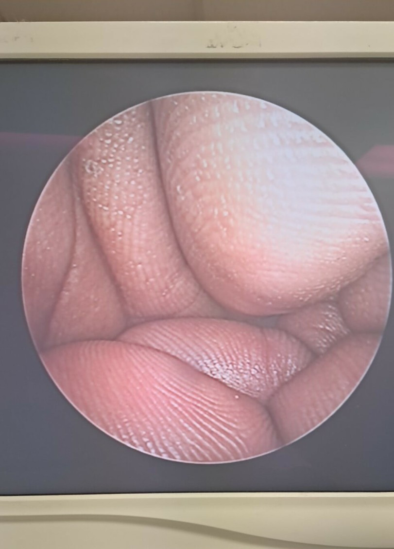 Hologic MyoSure 40-200 Operative Hysteroscope w/40-201 Removable Outflow Channel