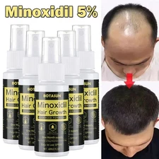 Minoxidil 5% Extra Strength for Men Anti Hair Loss Spray Fast Grow Essence 60ml