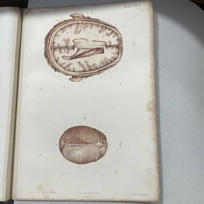 Anatomie écorché,gravure voute crane et cavité cranienne 1867, paulet et Sarazin - Photo 1/2