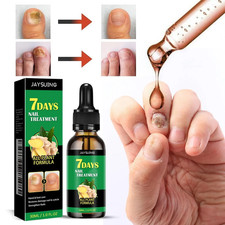 7 Days Nail Fungus Treatment   Extra Strength Repair for Nails  Cuticles 30ML