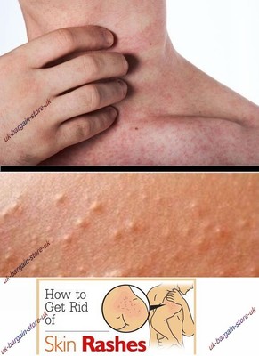 demodex zinc oxide