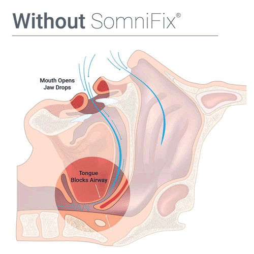 SomniFix ASM11 Sleep Strips for Better Nose Breathing - Picture 2 of 21