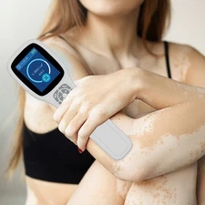 308nm Excimer UV Light Therapy for White Spot Skin Diseases Blue Light Treatment