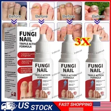1-3PCS-Fungi-Nail Anti-Fungal Liquid Solution Kills Fungus That Can Lead To Nail