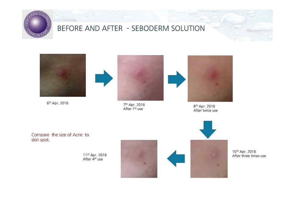 Acne treatment Intensive Anti Acne Serum anti sebum blemish prone skin 50ml  - Image 4 of 4