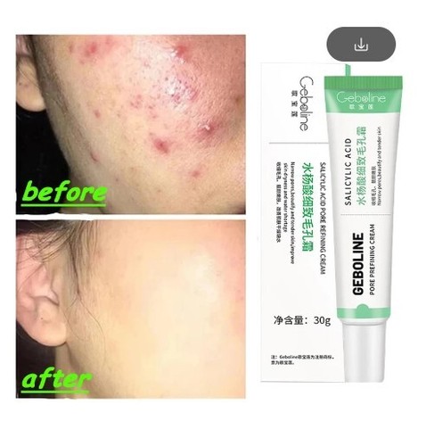 CURA COREANA CREMA RESTRINGENTE VISO BRUFOLI PUNTI NERI ACNE ACIDO SALICILICO - Imagen 7 de 8