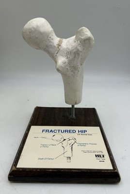 Health Edco  Fractured Hip Femur Bone Health Education Anatomical Model