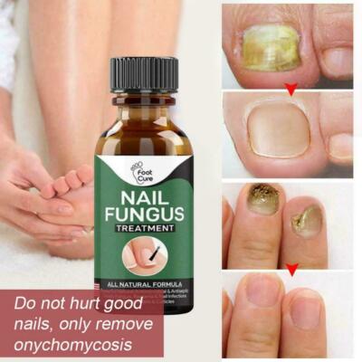 Nail Repair Essence  Nagelpflege Serum gegen Nagelpilz 30ml - Nagelpflege Set