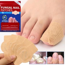 21pcs Nail Fungus Patch Waterproof Nail Repair Patch Ingrown Correction Sticker