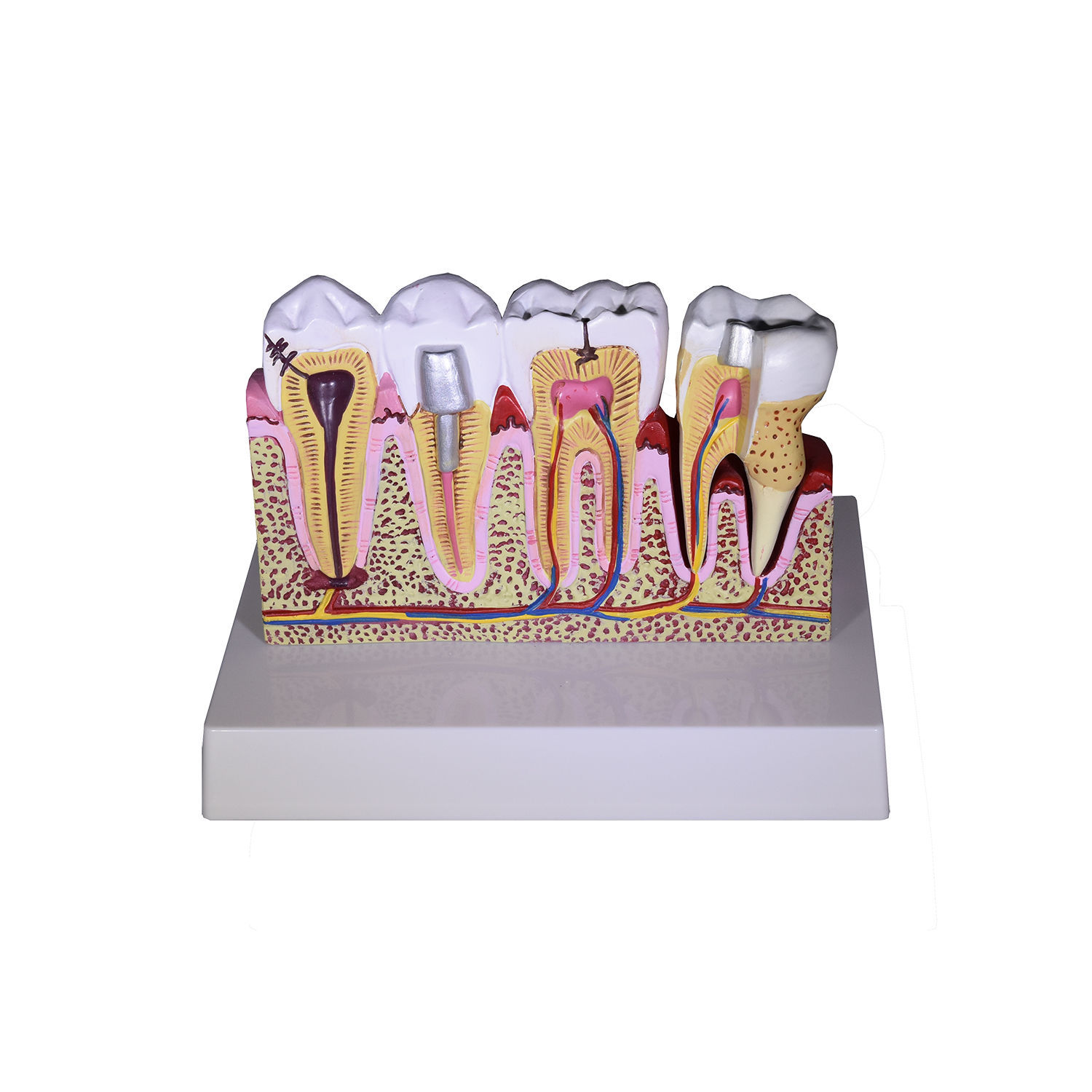 Redland  Dental Demonstration Teeth Educational Model -3339 Model 4