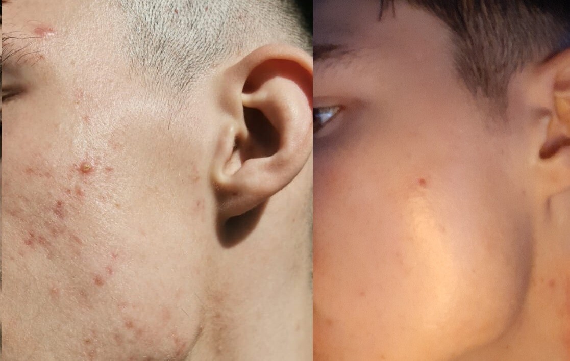 Oxygel- Extra stark ozonisiertes Olivenöl 100g - Beste Akne Therapie!