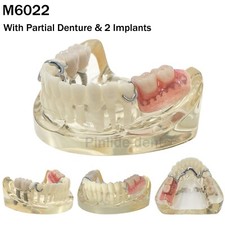 Dental Typodont Implant Restoration Teeth Model with Partial Denture M6022