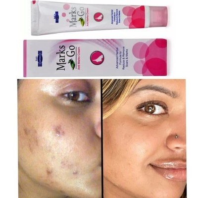 Hapdco Marks Go Creme 25g Hilft Hautunreinheiten, Augenringe und Brandflecken...