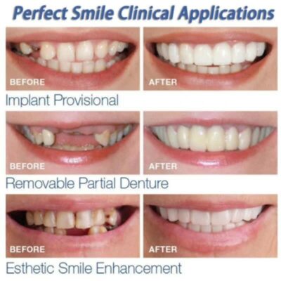 Facettes Dentaires Cosmétiques Flex Fit - Fausses Dents Confort - Prothèses Amovibles - Neuf
