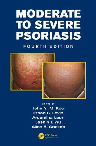 Moderate to Severe Psoriasis, Hardcover by Koo, John Y. M., M.D. (EDT); Levin...