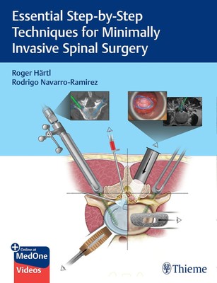 Essential Step-by-Step Techniques for Minimally Invasive Spinal Surgery | Buch