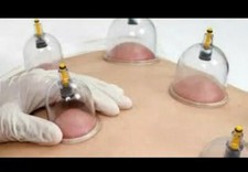 Coventry wet Hijamah cupping therapist 