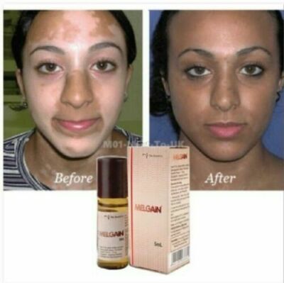 Melgain Lotion for Vitiligo White Spots Patches Re Pigmentation 5ml USA FS