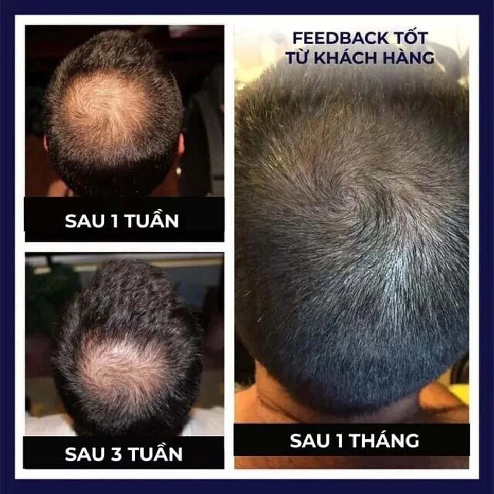 FEG Organic Anti Hair Loss Hair Growth Cure Oil For Thicker Long Hair - 50ml - Image 3 of 4