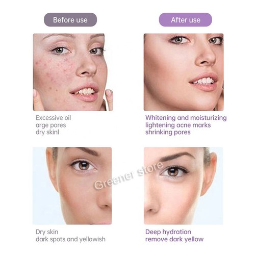 Painless Face Skin Lifting No-Needle Nano Therapy Machine Wrinkle Acne Removal - Picture 14 of 19