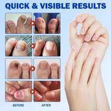 21pcs/box Fungal Nail Care Patches, box 8H Overnight Toenail Repair Care