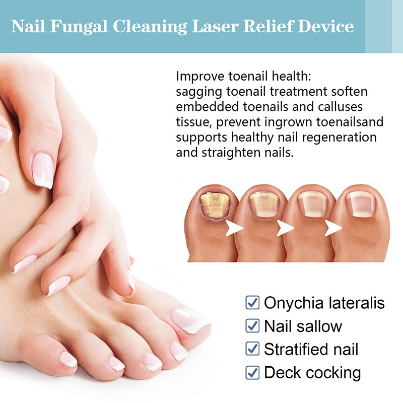Fungal Nail Lasers Device Repair Fast Nails Fungus Onychomycosis Repair
