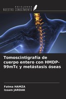 TomoscintigrafíA De Cuerpo Entero Con Hmdp-99Mtc Y MetáStasis óSeas Issam Jardak