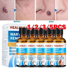Wart Remover Liquid Skin Tag Mole Remover Eliminate Feet Corn Wart Remove Liquid