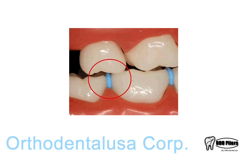 Anelli Separatori Blu Radiopachi - Foto 5