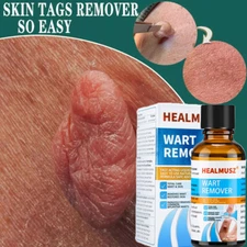 Wart Remover Liquid Feet Corn Wart Remove Liquid Skin Tag Mole Remover Eliminate