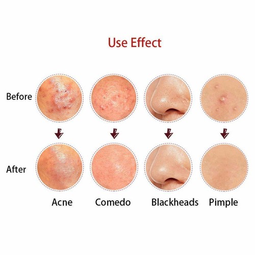 Blackhead Whitehead Remover Tool Comedone Spot Pimple Blemish Extractor Kit Set - Picture 10 of 12