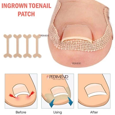 Pedimend™ Toe Nail Straightener Ingrown Toenails Paronychia Correction Patch- UK