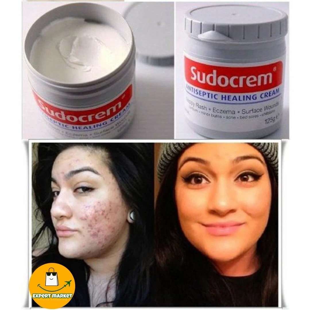 Sudocrem Antiseptic Healing Skin Cream- Nappy Rash, Acne, Eczema, Wounds