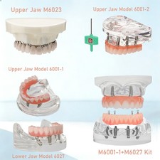 Dental Implant Model Overdenture Upper/Lower jaw Teeth Model with 4/6 Screws