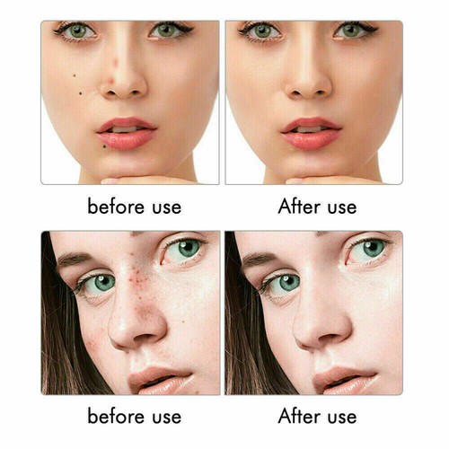 9 Level Skin Tag Remover Laser Pen Spot Mole Freckle Tattoo Removal Machine - Picture 3 of 14