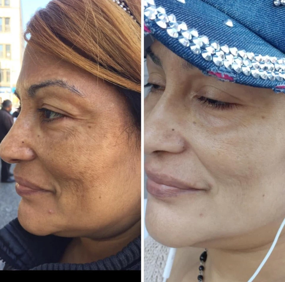 Super Skin Lightener Cream, Eliminan Las Manchas Oscuras Para Piel Clara, 5 oz. - Image 3 of 4