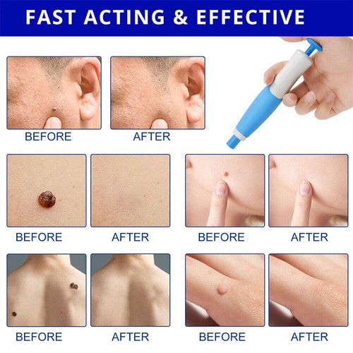 2 in 1 Micro Skin Tag Remover Device Kit Safe Painless Removal 2-8 mm Band Tool - Picture 5 of 9