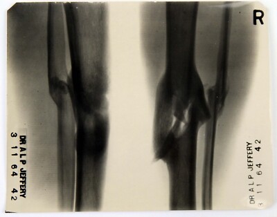 Original Vintage 1964 Hospital Medical X Ray Print Knochenbruch Harley Street #A