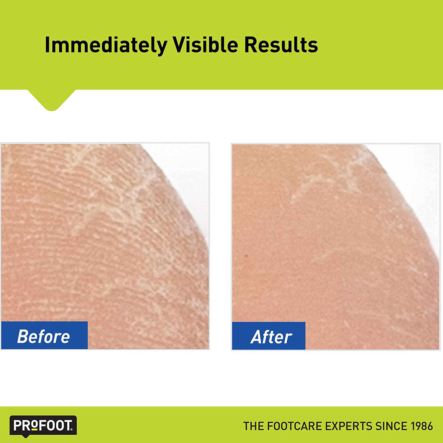 Profoot Heel Rescue Foot Cream 16 Ounce Bottle, 2 Pack, for Cracked, Calloused o